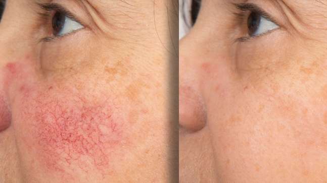 Okidia Sérum Anti Rojeces: Calma total para tu piel
